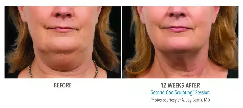 reduce a double chin