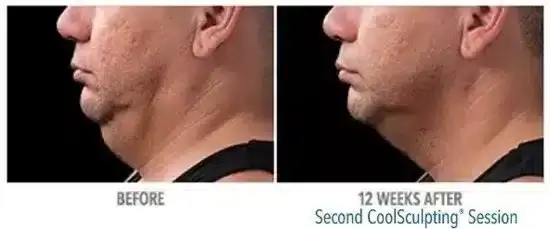 how-to-get-rid-of-a-double-chin-coolsculpting-skinney-medspa-550x229
