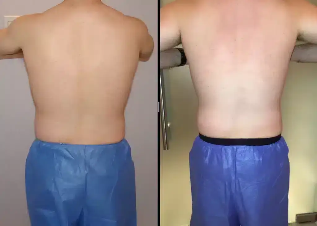 coolsculpting-before-and-after-men-1024x728