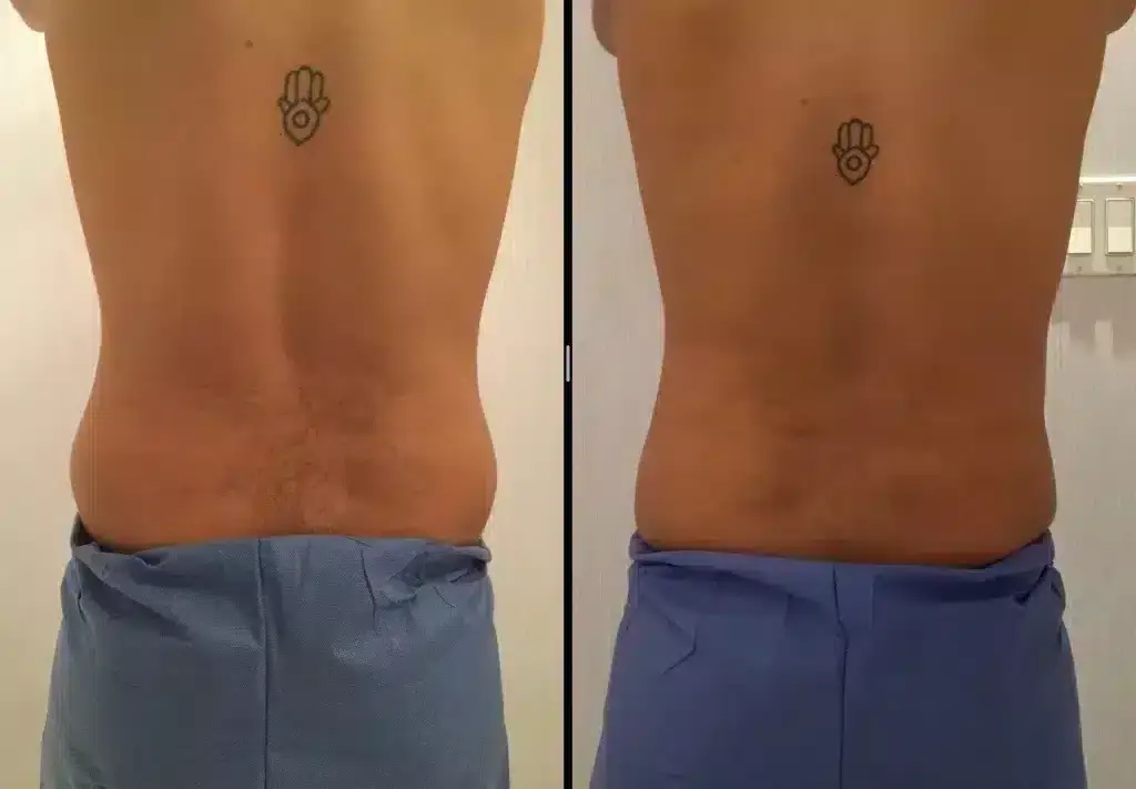 coolsculpting-before-and-after-men-love-handles-1024x711