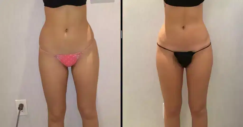 coolsculpting-inner-thighs-before-and-after-1024x536