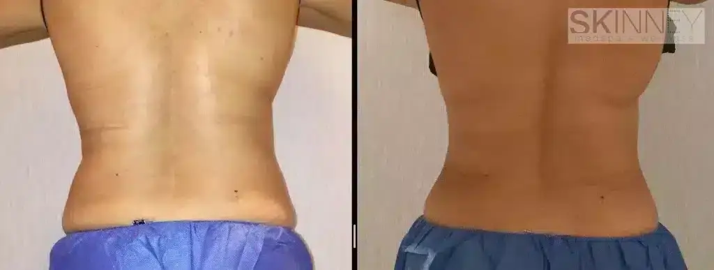 coolsculpting-love-handles-before-and-after-1-1024x387