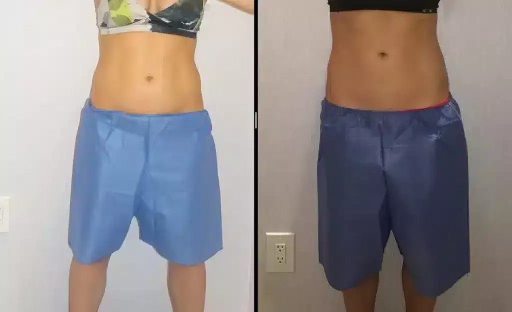 coolsculpting-love-handles-before-and-after-1024x625