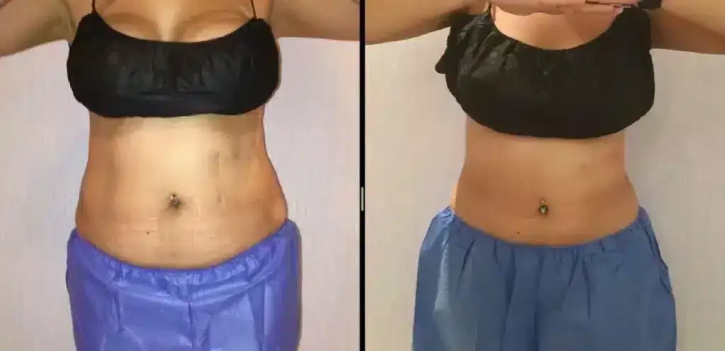 coolsculpting-stomach-fat-before-and-after-1024x497