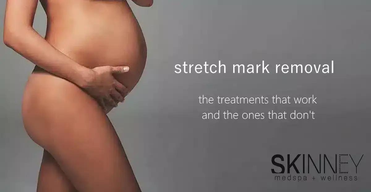 Different Stretch Mark Removal Treatments