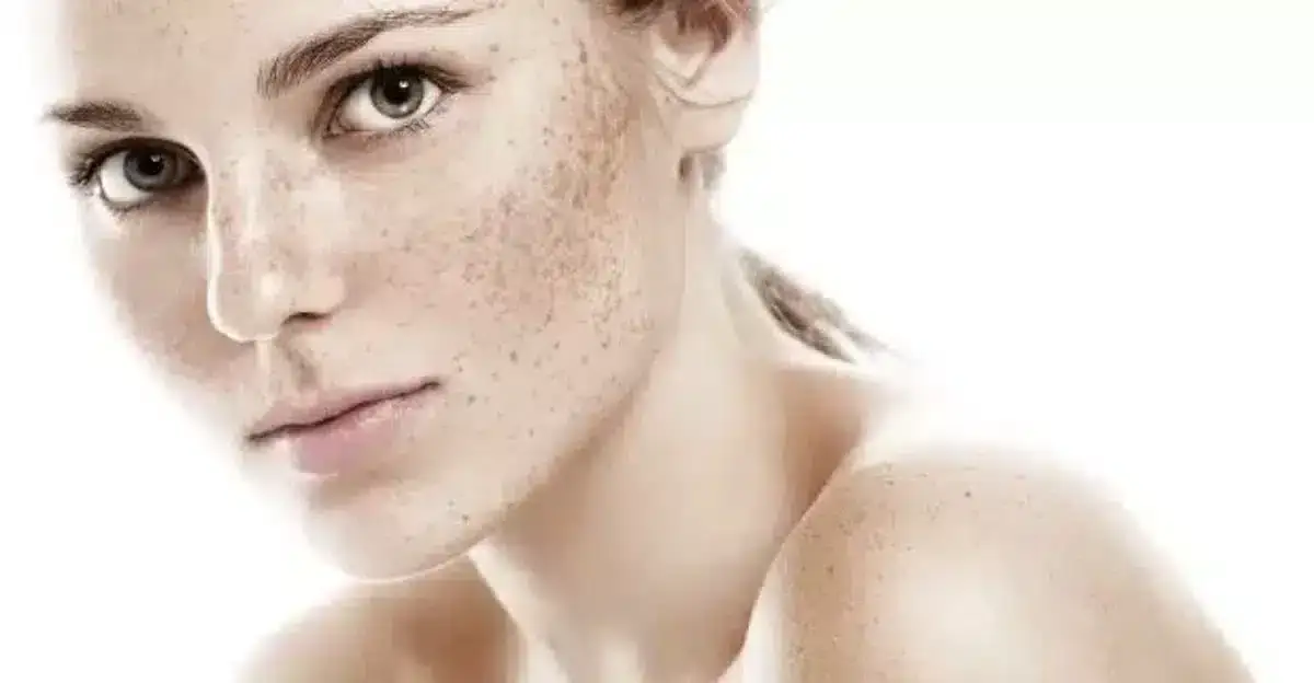Hyperpigmentation: Understanding Freckles, Acne Marks, Melasma, and Sunspots