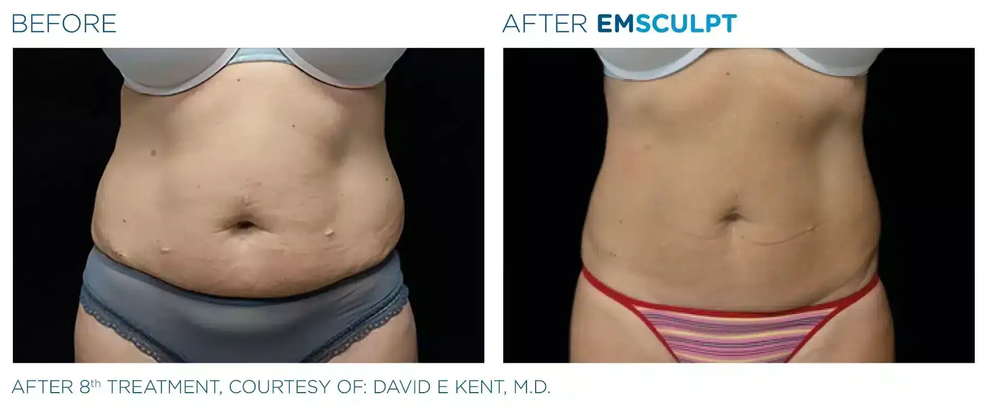 EMSCULPT BEFORE AND AFTER | REAL PATIENT RESULTS