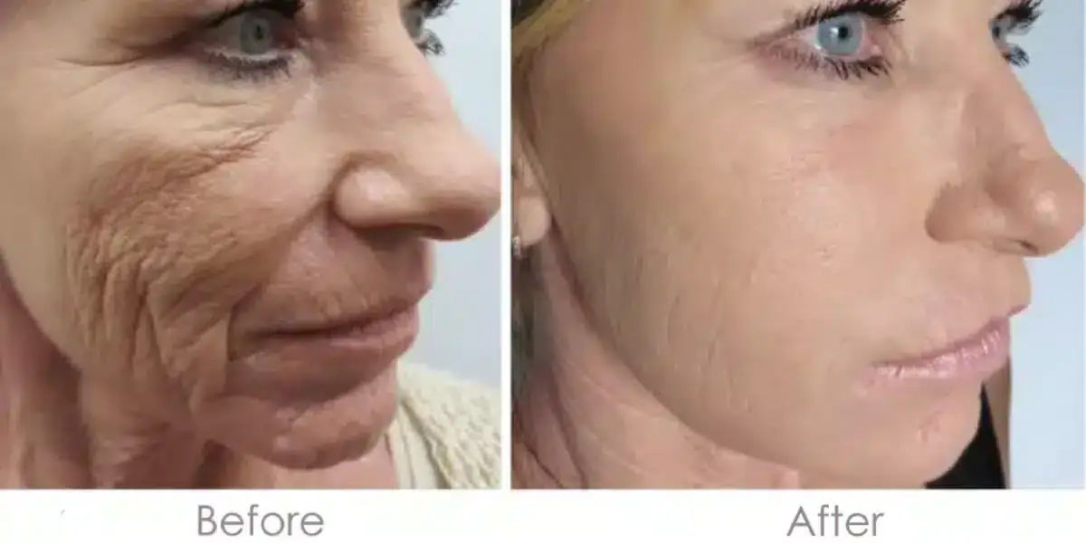 Microneedling Before and After | Real Patient Results