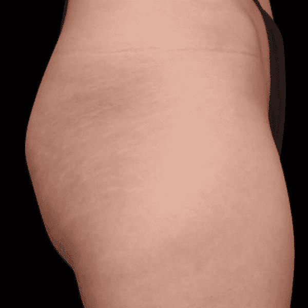 Buttocks before emsculpt treatment at Skinney Medspa.