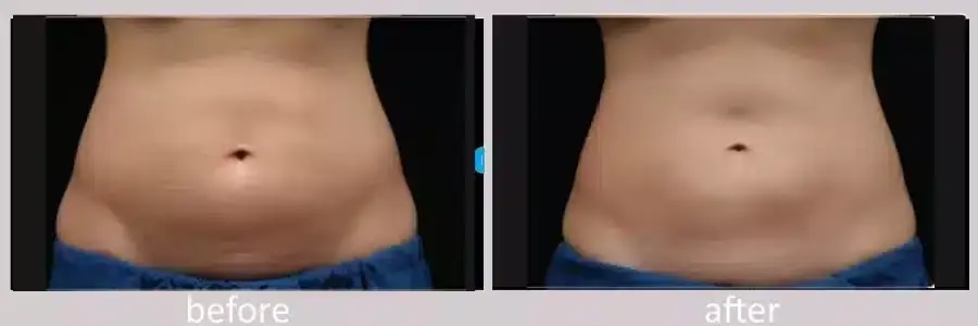 coolsculpting-before-and-after-10-900x300