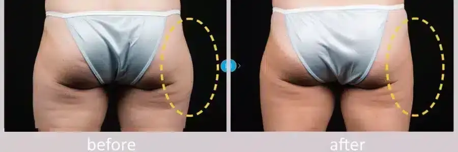 coolsculpting-before-and-after-4-900x300