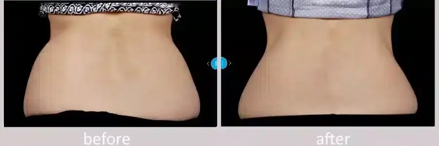 coolsculpting-before-and-after-5-900x300