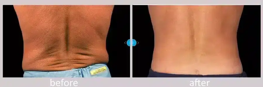 Sculpting a Smaller Waist with CoolSculpting Before & After Photos New  Jersey - Reflections Center