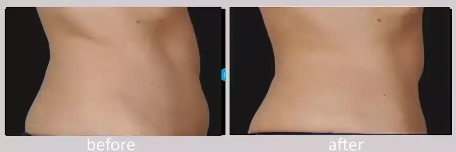 coolsculpting-before-and-after-9-900x300