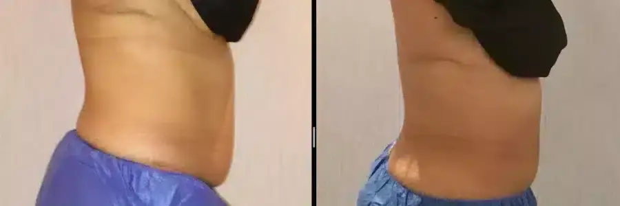 coolsculpting-before-and-after-belly-fat-1-900x300