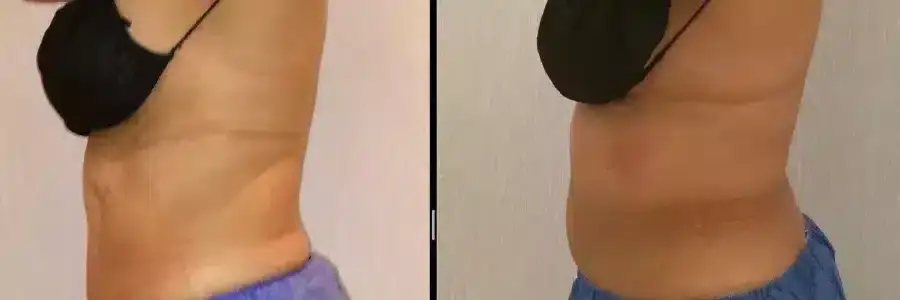 coolsculpting-before-and-after-belly-fat-2-900x300