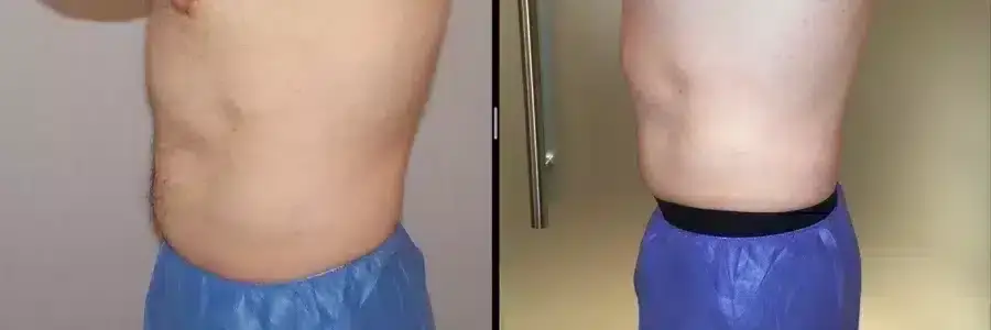 coolsculpting-before-and-after-belly-fat-3-900x300