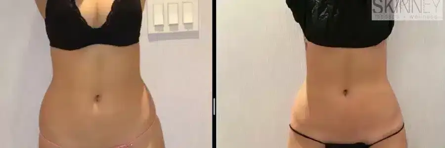 coolsculpting-before-and-after-flanks-900x300