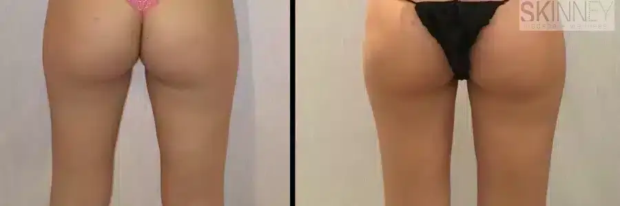 coolsculpting-before-and-after-inner-thigh-fat-2-900x300