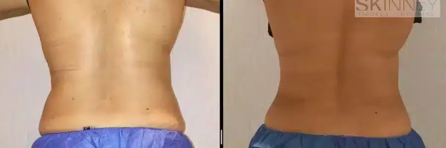 coolsculpting-before-and-after-love-handles-1-900x300