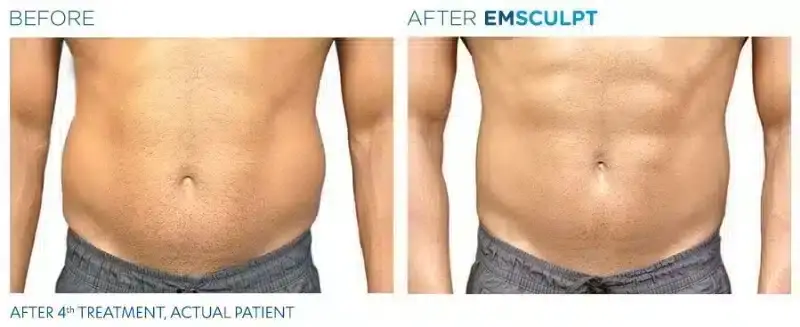 emsculpt-before-and-after-man