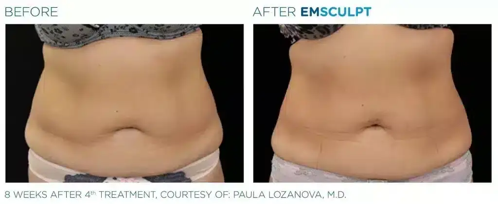 skinney-emsculpt-before-and-after-1-1024x421