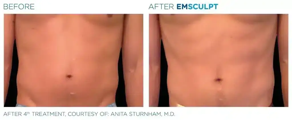 skinney-emsculpt-before-and-after-10-1024x421
