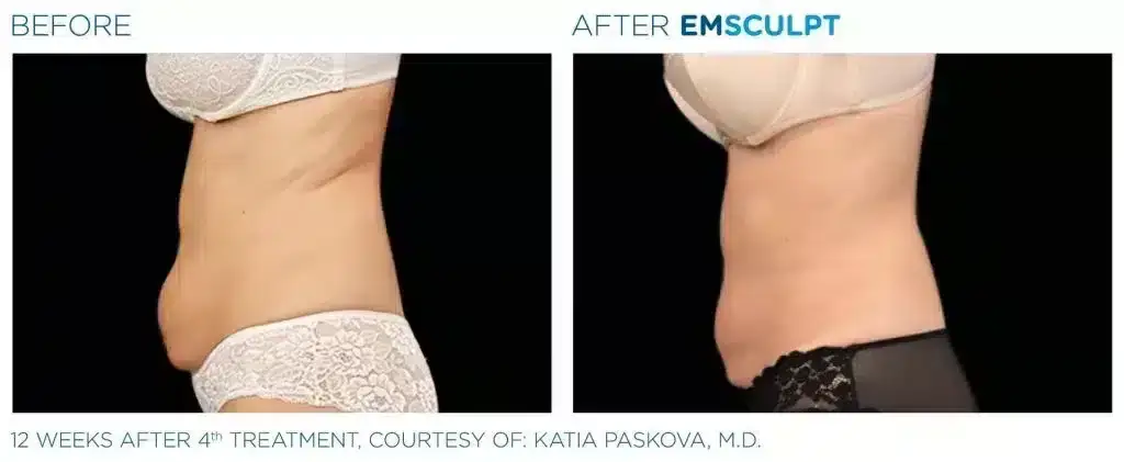 skinney-emsculpt-before-and-after-2-1024x421-1