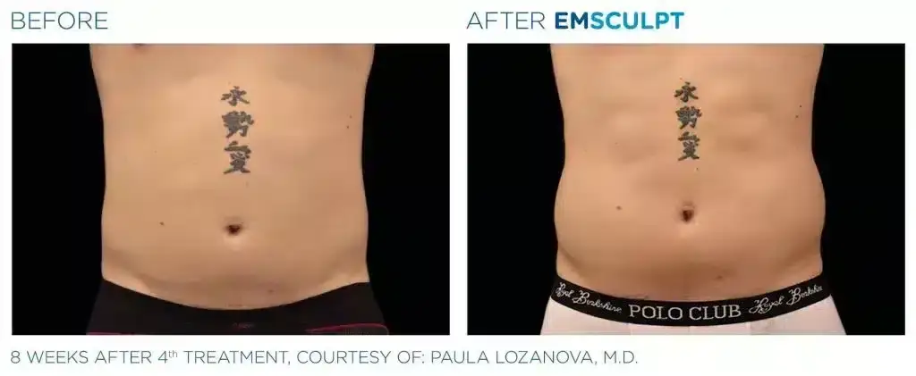skinney-emsculpt-before-and-after-3-1024x421-2