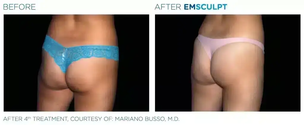 skinney-emsculpt-before-and-after-4-1024x421-3
