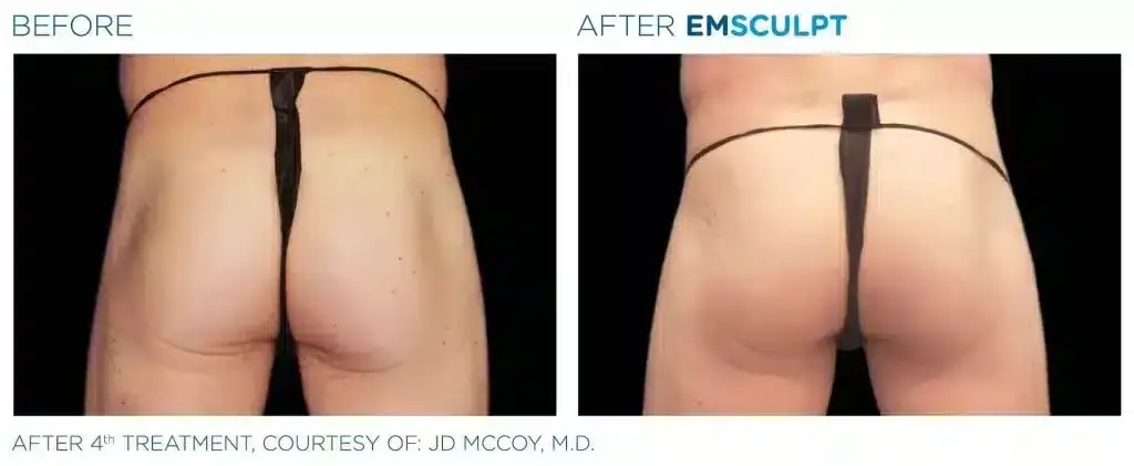 skinney-emsculpt-before-and-after-5-1024x421