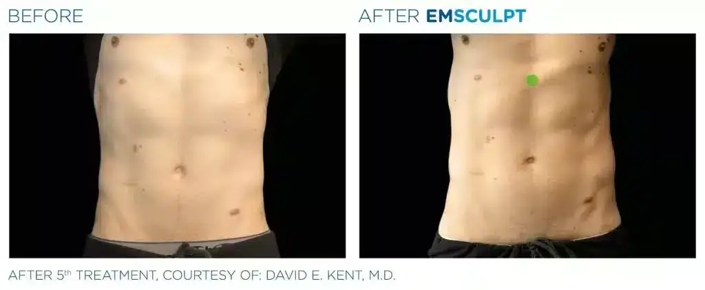 skinney-emsculpt-before-and-after-6-1024x421