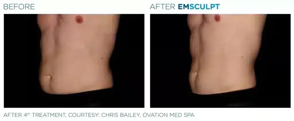 skinney-emsculpt-before-and-after-7-1024x421
