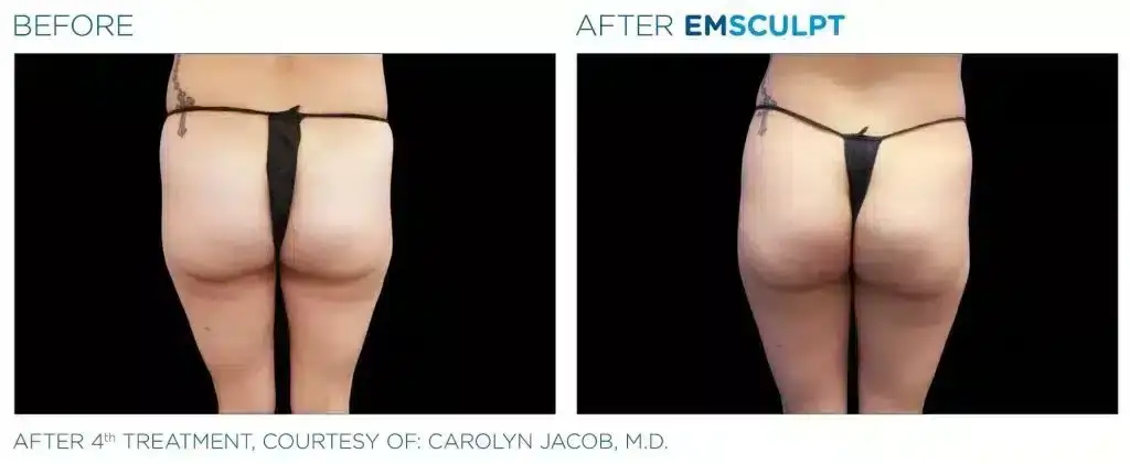 skinney-emsculpt-before-and-after-8-1024x421