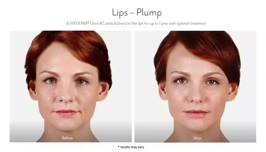 juvederm-before-and-after10