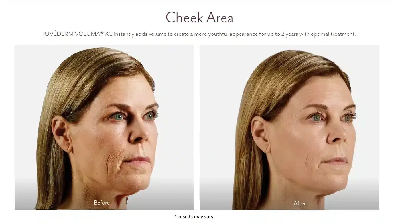 juvederm-before-and-after2