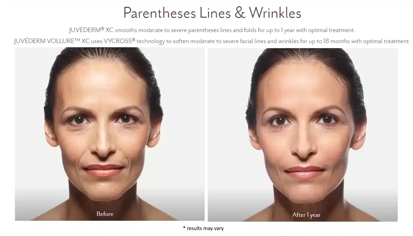 juvederm-before-and-after8