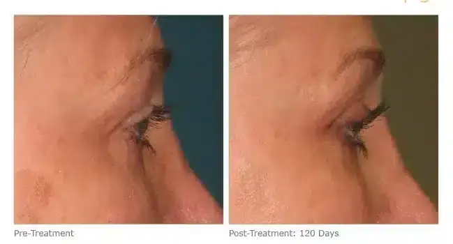 ultherapy-000p-033y_before-120daysafter_brow-800x350