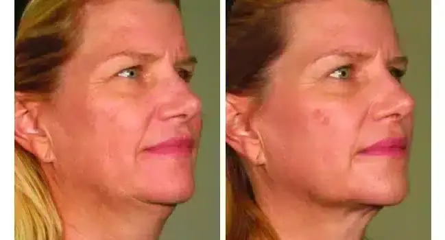 ultherapy-0283j-r_before-90daysafter_full-800x350