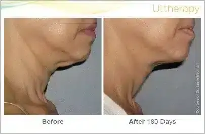 ultherapy_0008-0086w_beforeandafter_180day_1tx_neck2-1-800x350