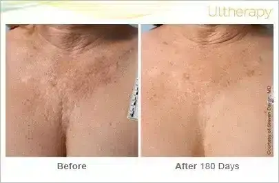 ultherapy_018p-d_beforeandafter-180day_1tx_chest-800x350