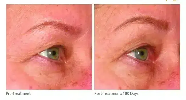 ultherapy_0196d-w_beforeandafter_brow_low-res-1-800x350