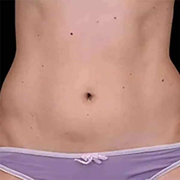 Skinney Medspa Emsculpt NYC After Woman's Abs Treatment