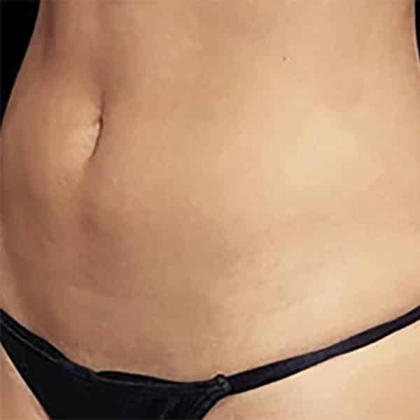 Skinney Medspa Emsculpt NYC After Woman's Abs Treatment