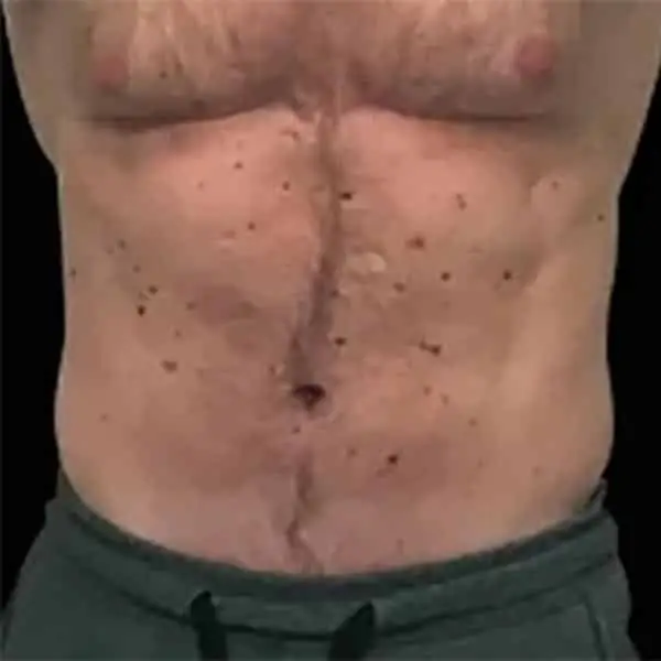 Skinney Medspa Emsculpt NYC After Man's Abs Treatment
