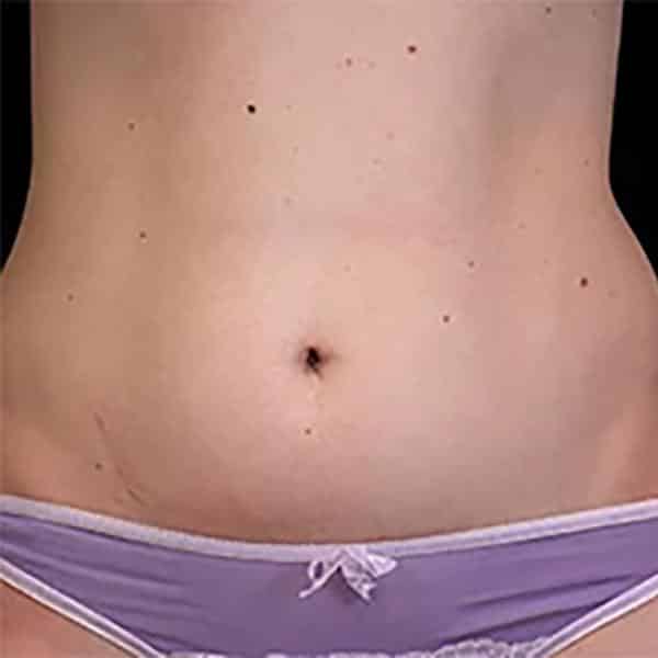 Skinney Medspa Emsculpt NYC Before Woman's Abs Treatment