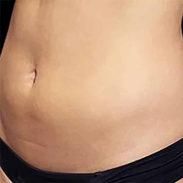 Skinney Medspa Emsculpt NYC Before Woman's Abs Treatment