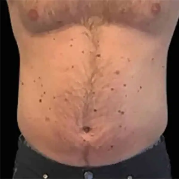 Skinney Medspa Emsculpt NYC Before Man's Abs Treatment