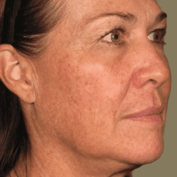 Skinney Medspa Treatments