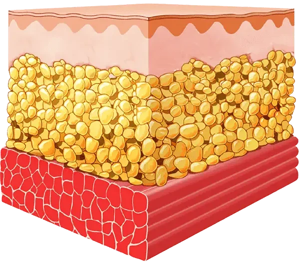 How Emsculpt NYC Works Before Treatment Diagram